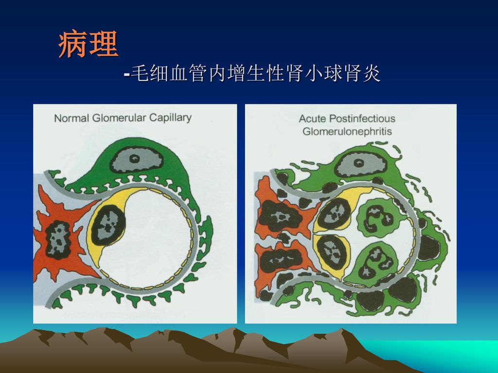 急性肾小球肾炎 acute glomerulonephritis